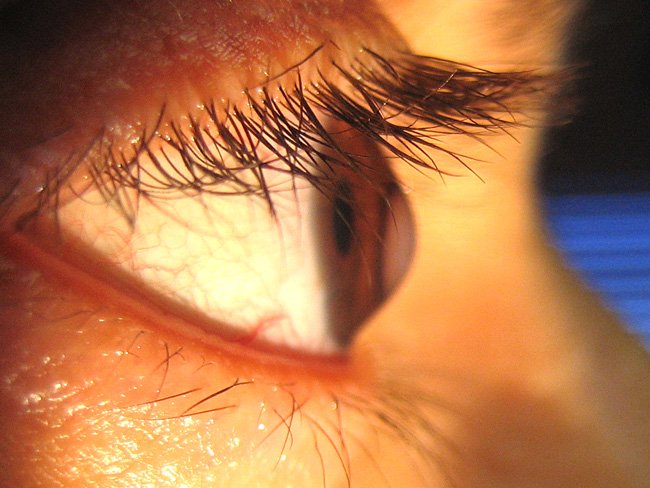 sintomas de ceratocone