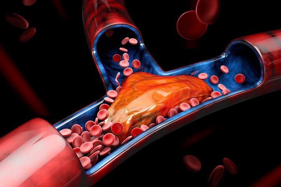 Trombose ilustração 3D